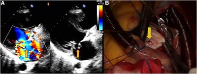 Mitral valve aneurysms: echocardiographic characteristics, formation mechanisms, and patient outcomes